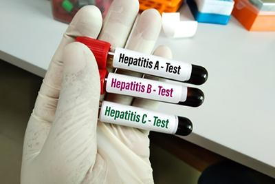 Hepatitis Panel Screening